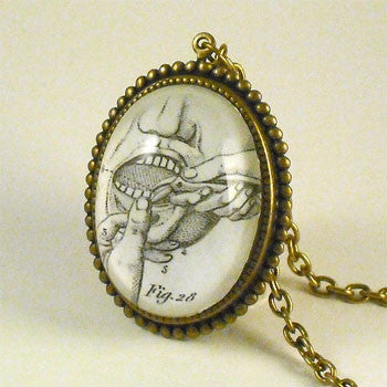 Pulling Teeth Engraving from 19th Century Dental Engraving Necklace